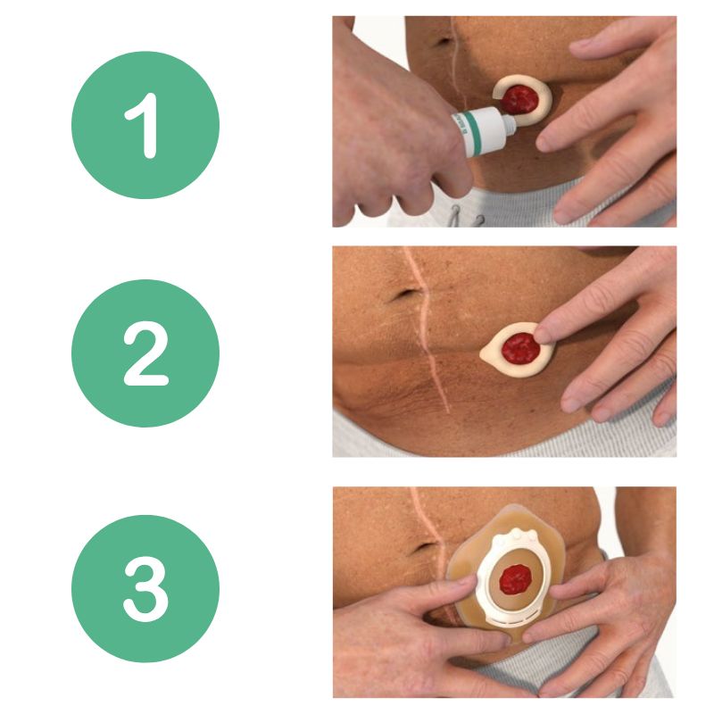 Ally Pasta Barrera Cutanea Ostomia 80grs - tubotiquin.cl