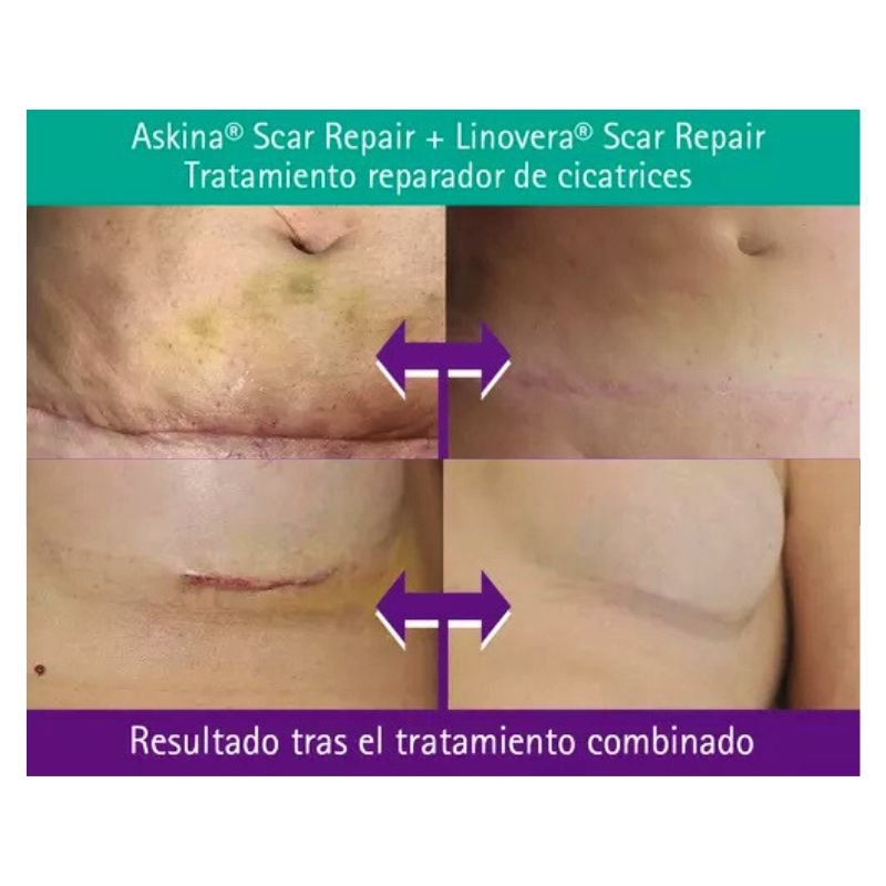 Linovera Scar Repair 15 gr - tubotiquin.cl