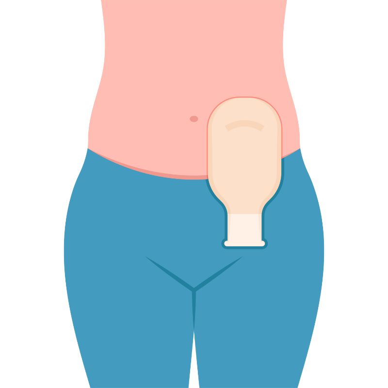 Bolsa ostomia precio