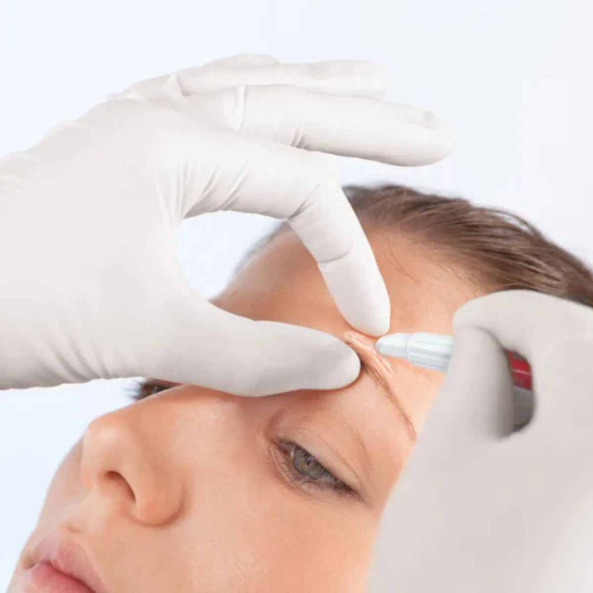 Aplicación precisa de Leukosan Adhesive en herida facial — pegamento médico para cierre de piel usado por profesional de salud en Chile.