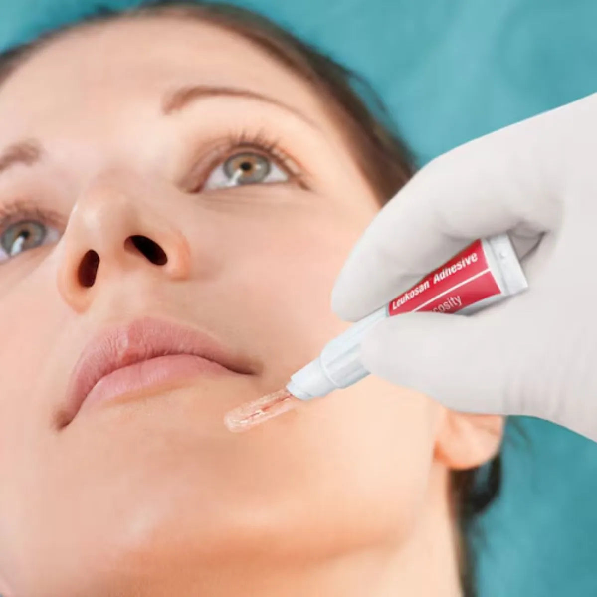 Aplicación clínica de Leukosan Adhesive — pegamento para heridas y adhesivo tópico para piel utilizado por profesional de salud en Chile.